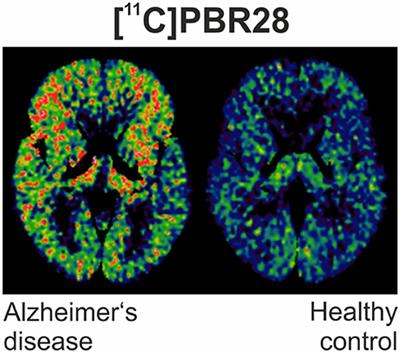 In vivo Imaging of Glial Activation in Alzheimer's Disease